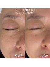 プリンセスローズ 焼津店(Princess Rose)/ムートン泡エステ