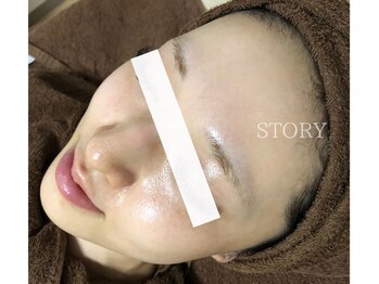 ストーリー 沼津店(STORY)/ハーブピーリング専門店STORY