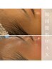 【お化粧ノリUP♪艶肌フェイシャル全顔WAX脱毛】初回のみ8,800→6,600