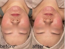 ビュウナ 銀座(BEAUNA)/カルテットモード全顔