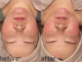 ビュウナ 銀座(BEAUNA)/カルテットモード全顔