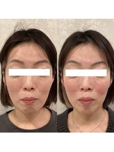 ラバ 名古屋栄店(LAVA)/小顔コルギ【リフトアップ】