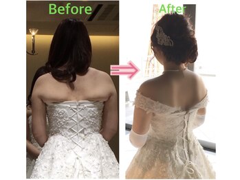 まつの鍼灸院/ブラの上のはみ肉を撃退したい方