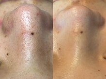 エミナル(Eminal)/◆毛穴フルコース　1回