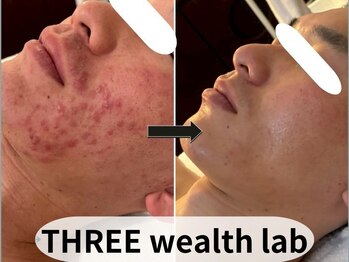 スリーウェルスラボ 恵庭店(THREE wealth lab)/ハーブピーリング症例