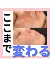 アエ(ae)/話題！プラズママイクロニードル