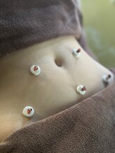 井荻癒し鍼灸院/お腹へのお灸