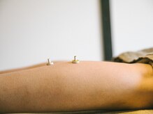 アキュネ 福岡薬院店(acune)/福岡/薬院/美容鍼/美肌