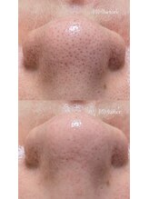 クレヴィー(Creviy)/3D毛穴洗浄×ハーブピーリング