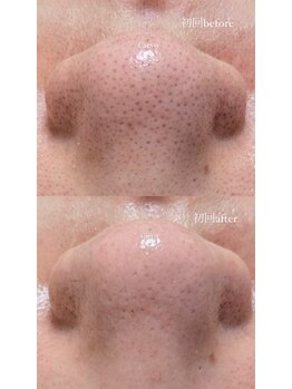 クレヴィー(Creviy)/3D毛穴洗浄×ハーブピーリング