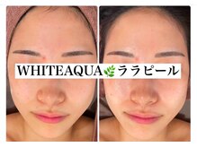 ホワイトアクア つくば店(WHITE AQUA)/ララピール/ つくば/茨城/艶肌