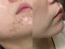 エミナル(Eminal)/◇プロセル　フェイシャル