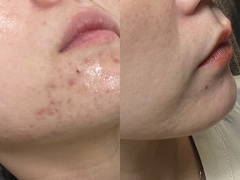 エミナル(Eminal)/◇プロセル　フェイシャル