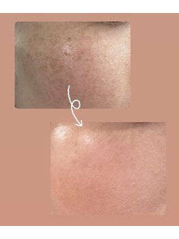 エステティック アントワネット/高濃度水素LEAP+ララピール8回