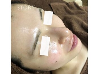 ストーリー 沼津店(STORY)/ハーブピーリング専門店STORY