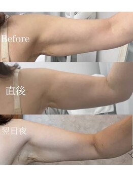 ファム 蓮台寺店(FAM)/レモンボトル 二の腕