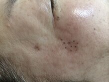 エメ(Aimer)/【シミケアした直後の写真☆】