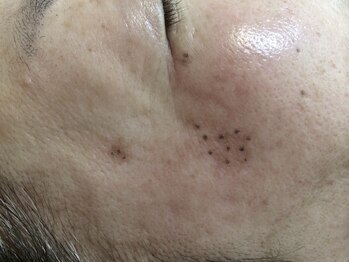 エメ(Aimer)/【シミケアした直後の写真☆】