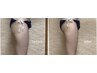 【全身痩せ】全身痩身90分×2回来店で短期脂肪分解44,000円→22,000円