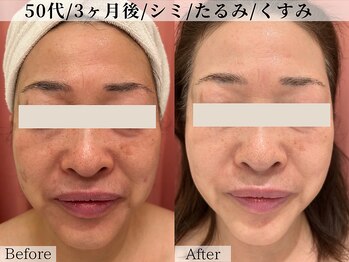 ベルタ(BELTA)/ケア前→3ヶ月後　シミ/法令線