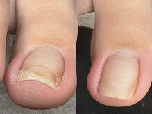 ヌル ネイル 堀江(NURU NAIL HORIE)/巻き爪矯正！上からのショット！