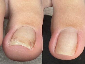 ヌル ネイル 堀江(NURU NAIL HORIE)/巻き爪矯正！上からのショット！