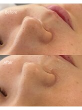 オン(on.)/《お客様症例》施術1回