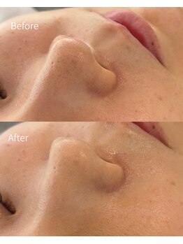 オン(on.)/《お客様症例》施術1回