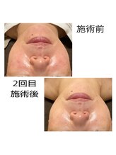 ヴァロ(Valo)/Eライト＋ヒト幹細胞導入