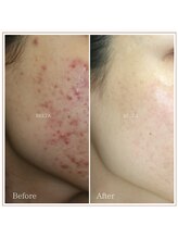 ベルタ(BELTA)/ケア前→14ヶ月後　ニキビ