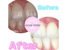 エクシアホワイトニング 沖縄宮里店/お客様ビフォア