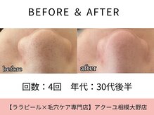 ア クーユ 相模大野店/毛穴洗浄/毛穴の黒ずみ/美肌