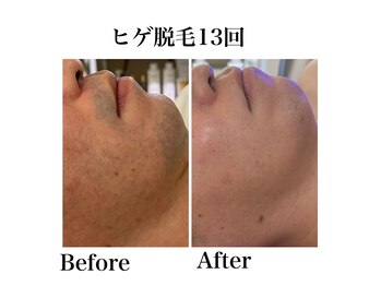 マーレン(Malen)/男性ヒゲ脱毛13回