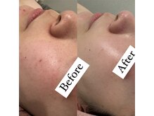 ミューズ(MUSE)/エクストラクション＋白玉ピール