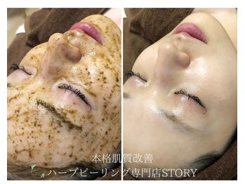 ストーリー(STORY)/ハーブピーリング専門店STORY