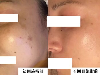 リコス(LICCO’S)/光フォト シミケア3回