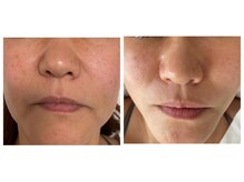 エステティックセラピー プレマ(PREMA)/輪郭、劇変わり～！