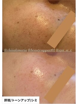 ミラビューティー(Mira Beauty)/小ジワ改善/ツヤ肌