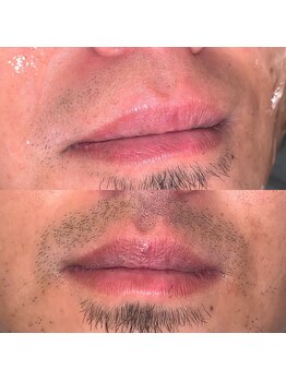 シド/鼻下髭 脱毛 2回目