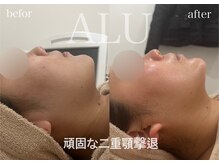 アルフォービューティ 難波店(ALU for beauty)/施術