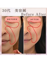 ハリプラス(HariPlus)/美容鍼ビフォーアフター