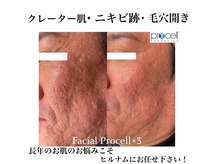 ヒルナム(Heal Nam)の雰囲気（プロセルは短期間で効果をご実感頂けるのも魅力の１つです！）
