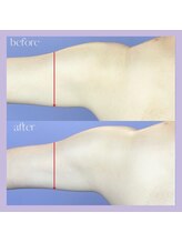 エクラ 天神店(ecla)/スッキリ二の腕