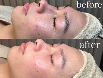 ラシックヘア 三木本店(LASSIC HAIR)/光フェイシャル（SR）結果写真☆