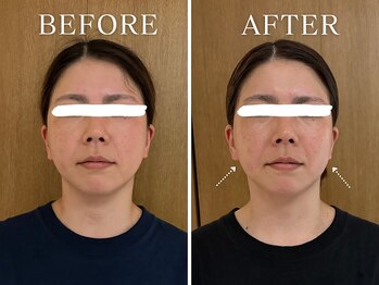 ヨサパーク ニコナ 三軒茶屋南口(YOSA PARK nicona)/ルルオンでの変化♪小顔/むくみ