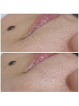 ウォーマル(warmaL)/フェイシャルワックス脱毛