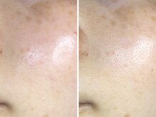 コハク(kohaku)/ララピール/ビフォーアフター