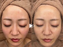 【圧倒的小顔】自社開発機器使用！脂肪撃退×たるみ改善のW効果◆医療提携の最新マイクロリフト￥13000