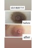 【ホットペッパー限定クーポン ローマピンク乳輪/乳頭￥220,000→￥132,000】
