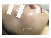 ストーリー 沼津店(STORY)/ハーブピーリング専門店STORY